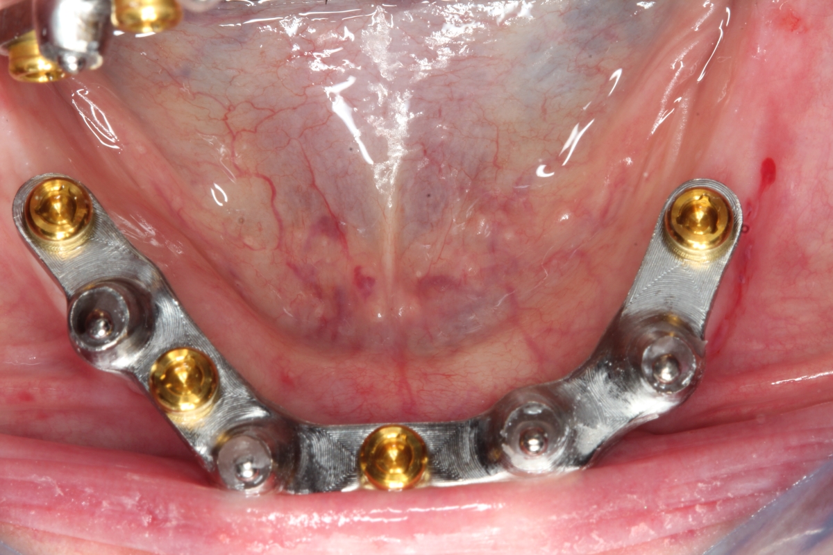 Denture Implants Help Keep You Comfortable