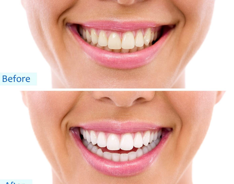 Teeth Whitening Services in Independence, Ohio. Bilski Family Dentistry