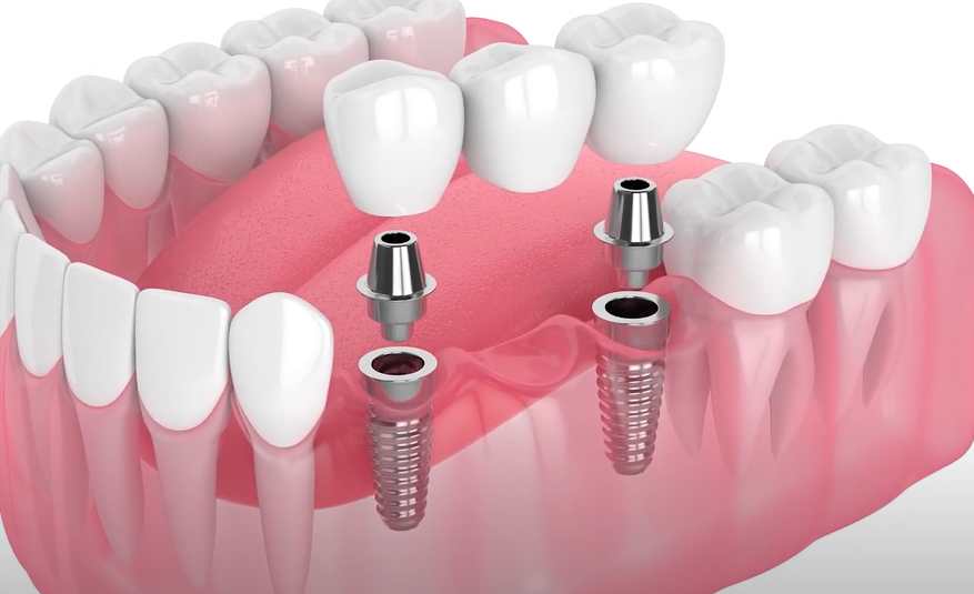 What Is A Dental Bridge?