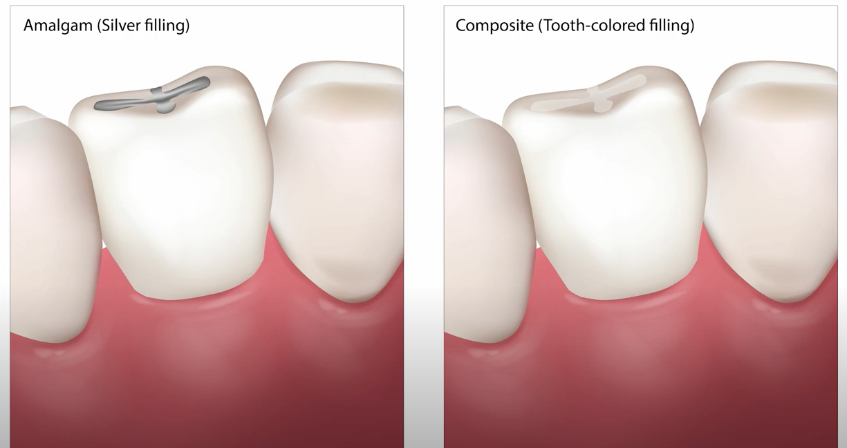 Lost a Filling  Here are a few Immediate Steps and Dental Solutions