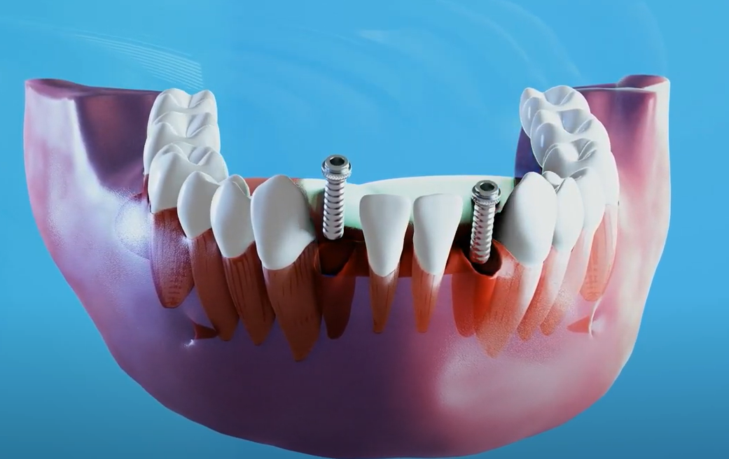 Expert Repair for Chipped and Cracked Teeth