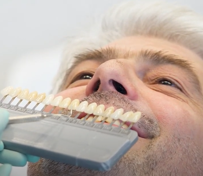 Dental Veneers: Proven Solutions for Cracked Teeth
