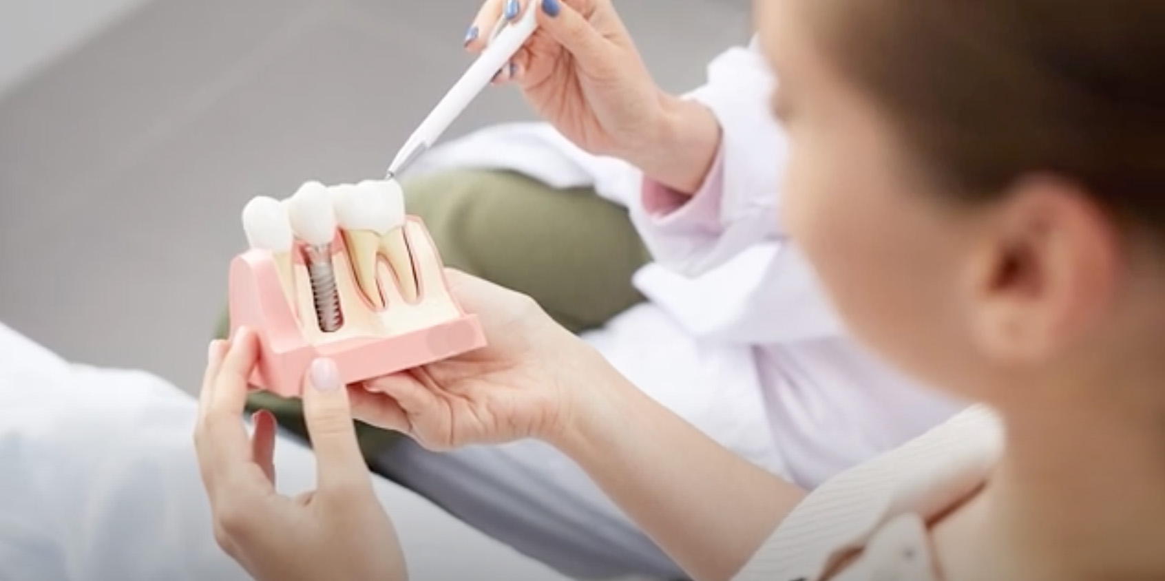 What to Expect After Getting Dental Implants: Tips for a Smooth Recovery Image