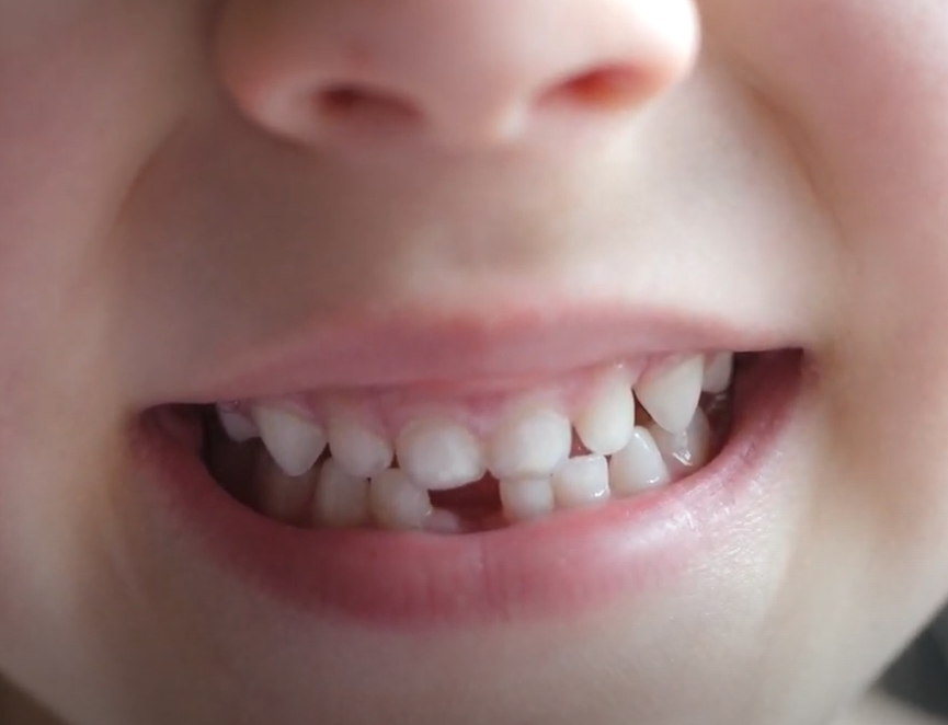 Late Baby Tooth Loss Image
