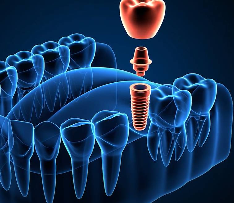 Safe Dental Implants and Protecting Your Gums  Health