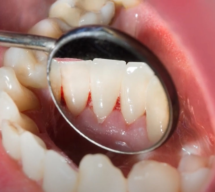 Sugar vs. Tobacco: Bilski Dentals Guide to Protecting Your Teeth
