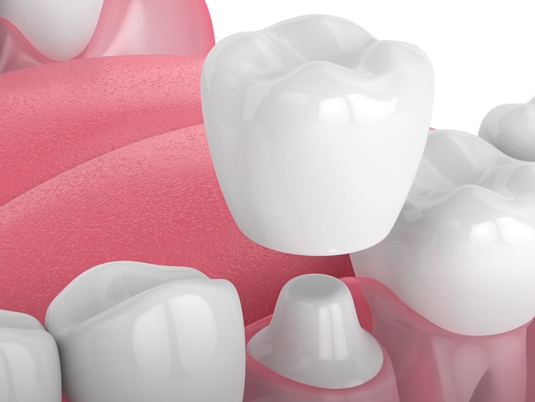 What Is A Dental Crown 