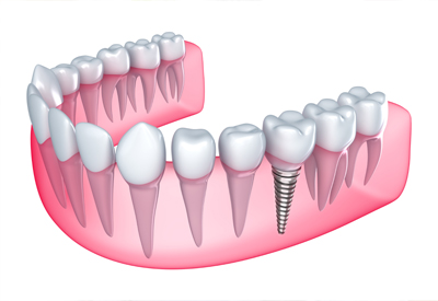 Set of teeth with a dental impant