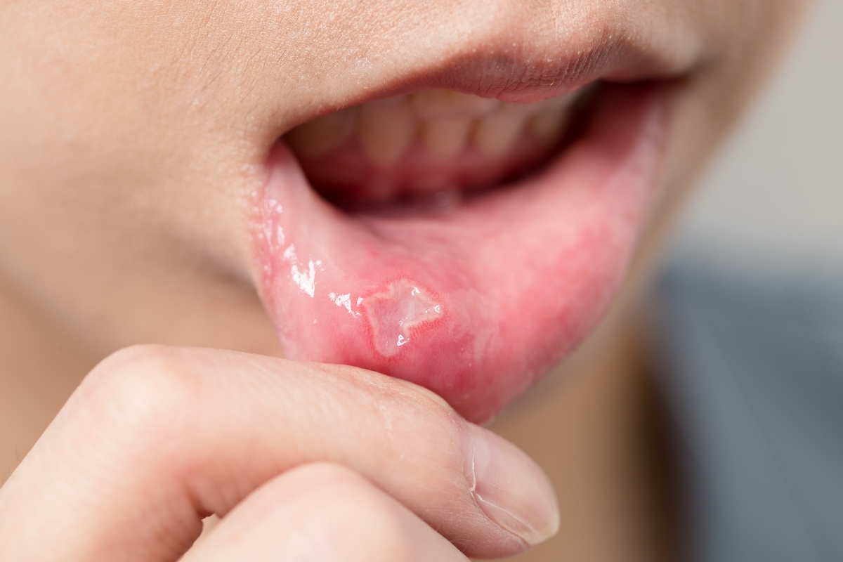 Treating Canker Sores at the Dentist