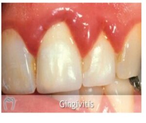 patient with gingivitis | Coshocton Dentistry