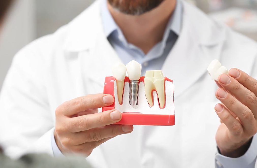 Choosing Between Dental Implants and Root Canals: Your Guide to Informed Decision Making at Coshocton Dentistry