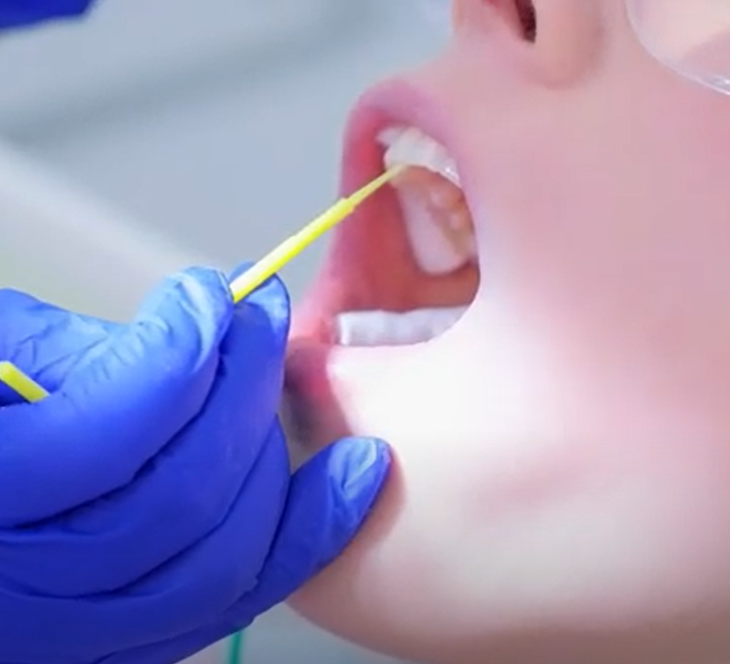 Elevate Your Oral Health: Discover the Benefits of Fluoride Varnish with Coshocton Dentistry