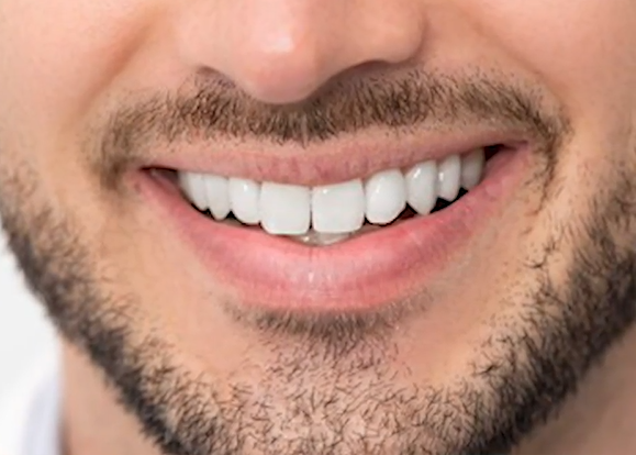Reclaim Your Radiant Smile: Effective Solutions for Tooth Discoloration at Coshocton Dentistry