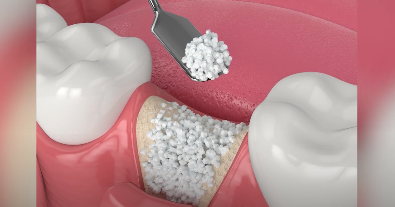 Cleft Palate Dentures