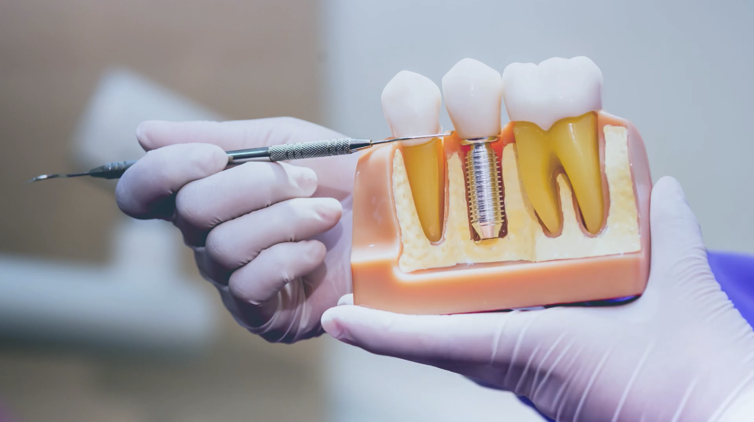 Mini Implants: The Affordable Dental Implants