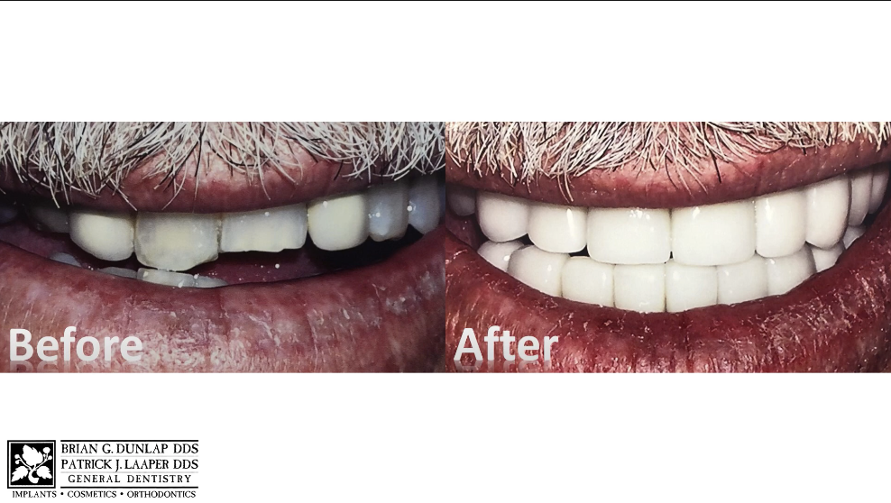 Anterior Crowns Can Change Your Smile