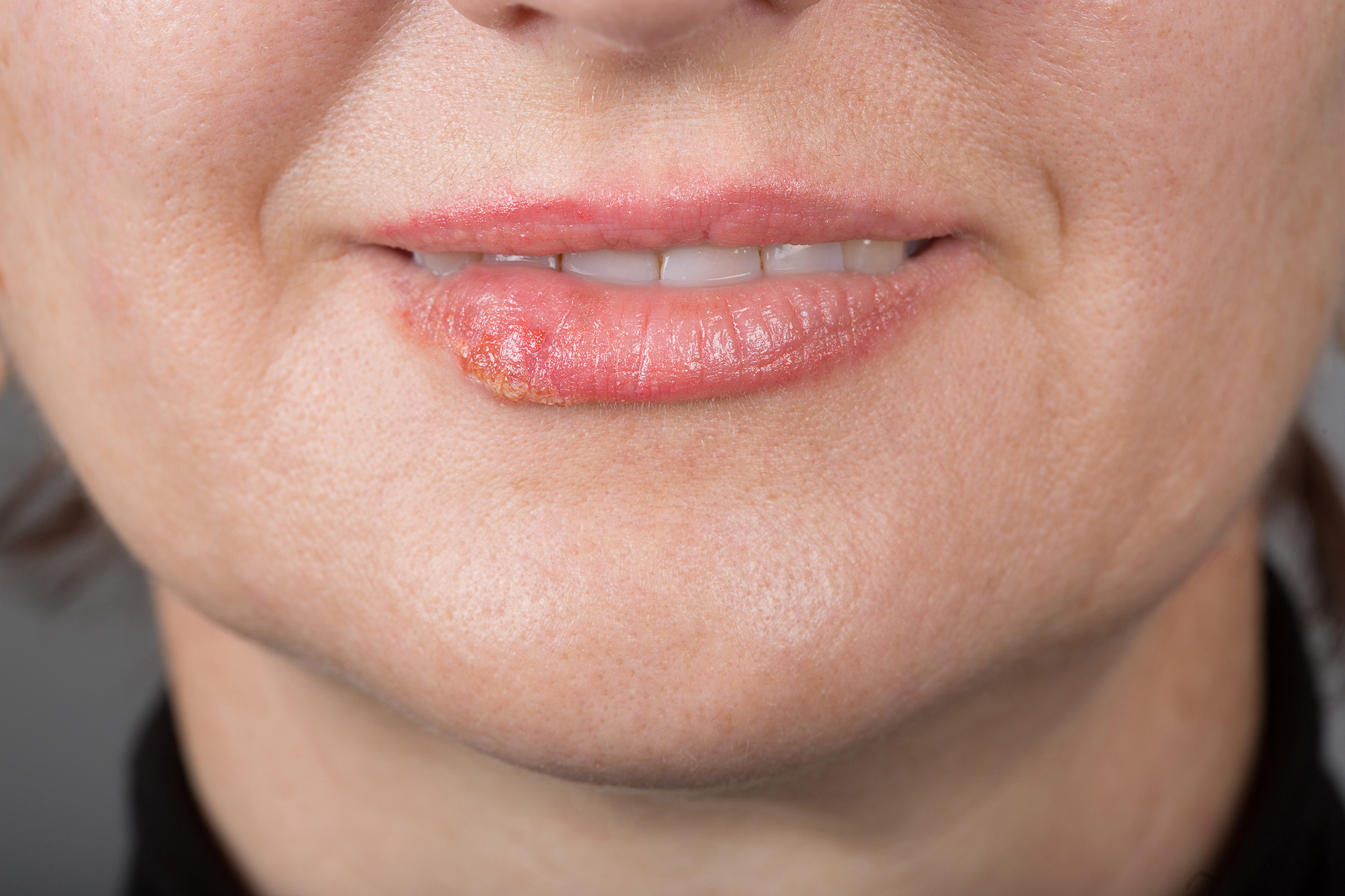 Mouth Ulcer and Canker Sores   Essential Things You Need to Know