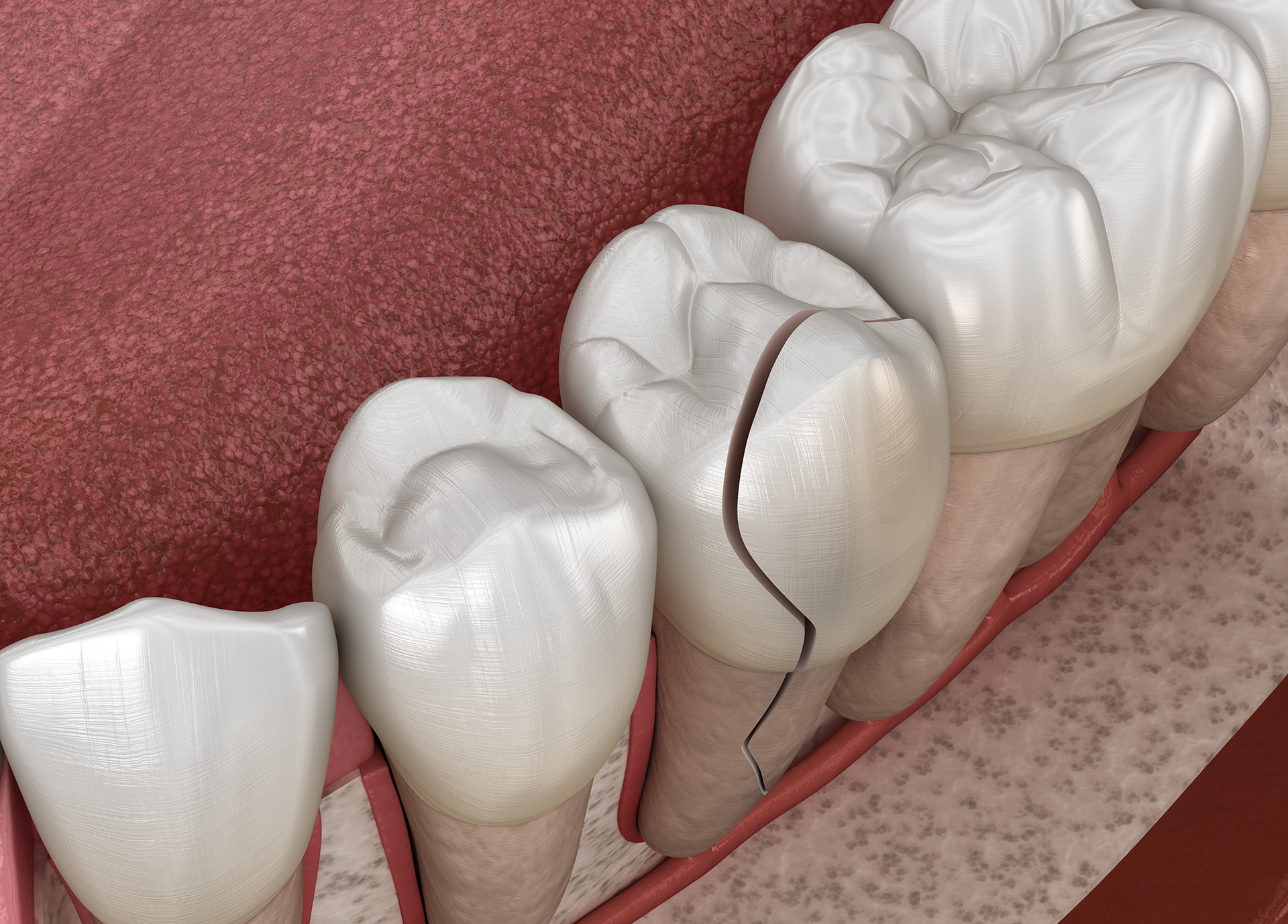 Is a Crown needed After a Root Canal?