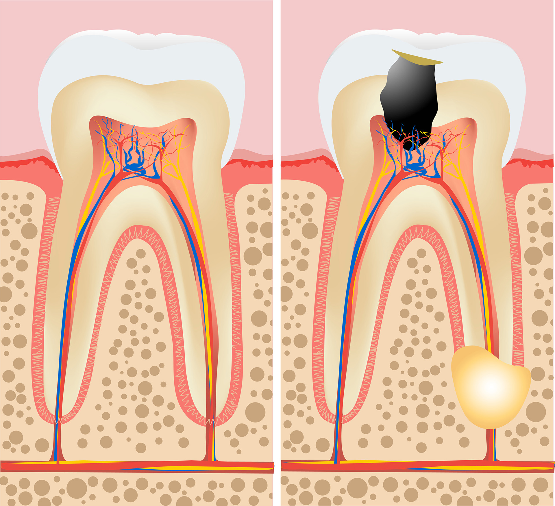 Are Root Canals Painful 