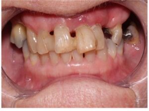 Patient with Gum Disease