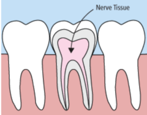 Root Canal Process 