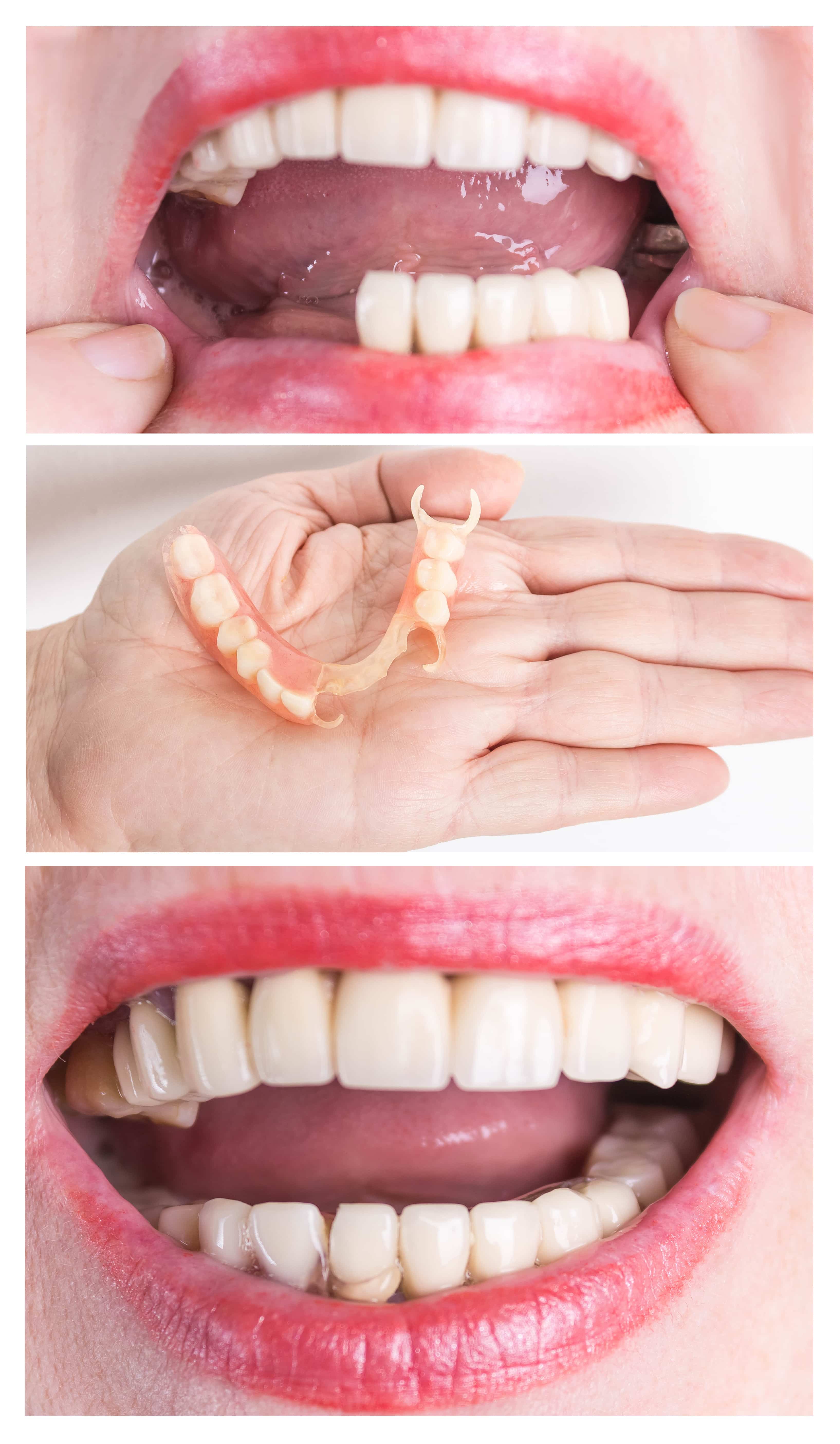 Bridges and Removable Partials