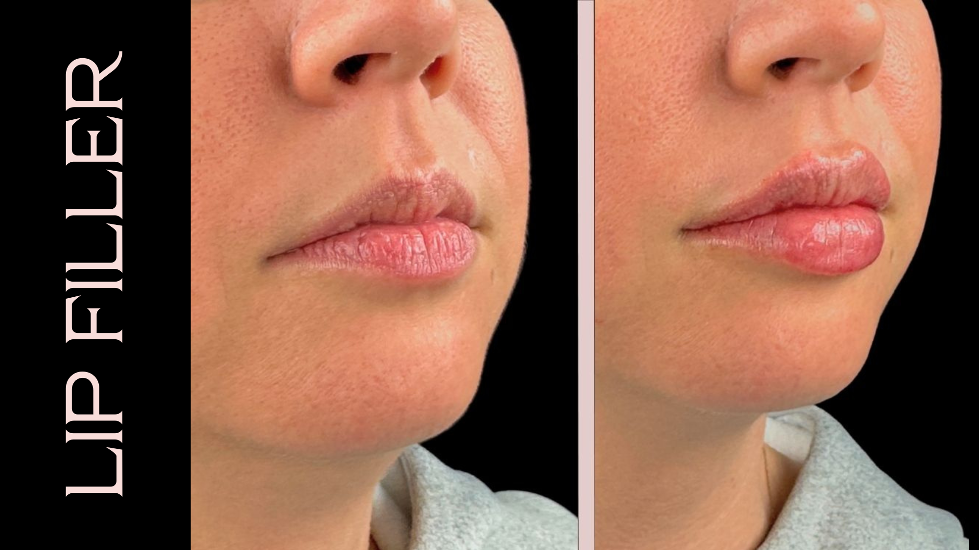 What to Expect Before, During, and After Lip Injections