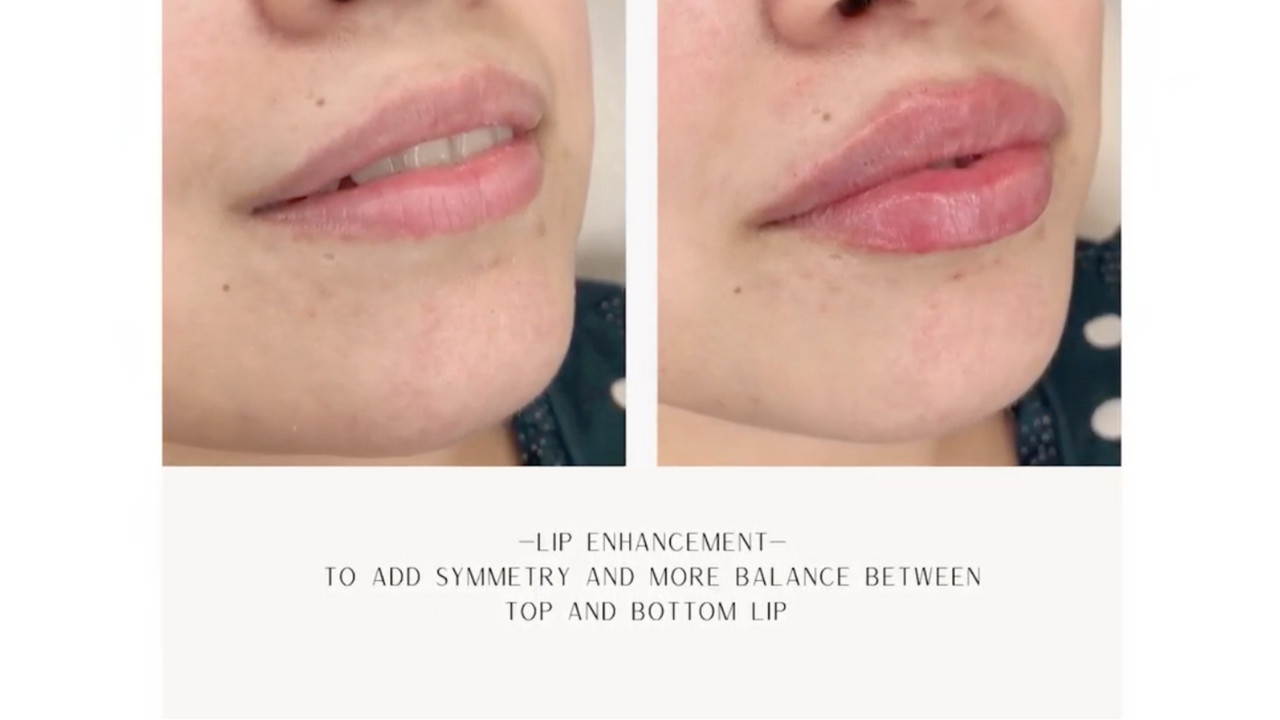 Lip Injections and Augmentation